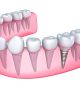 The Dental Implants Procedure, Benefits, and Maintenance