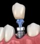 Replacing Missing Teeth? Implants Can Make a Remarkable Difference