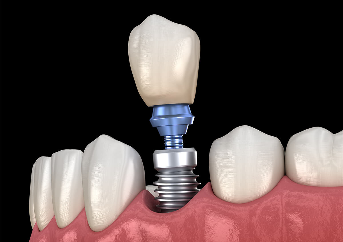 Tooth Implant Surgery in Keene NH Area